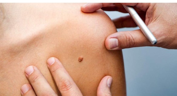 'New skin growth, size and colour of moles may be skin cancer: Doctors'