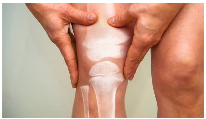 Covid-19 infection may induce severe bone loss, suggests study