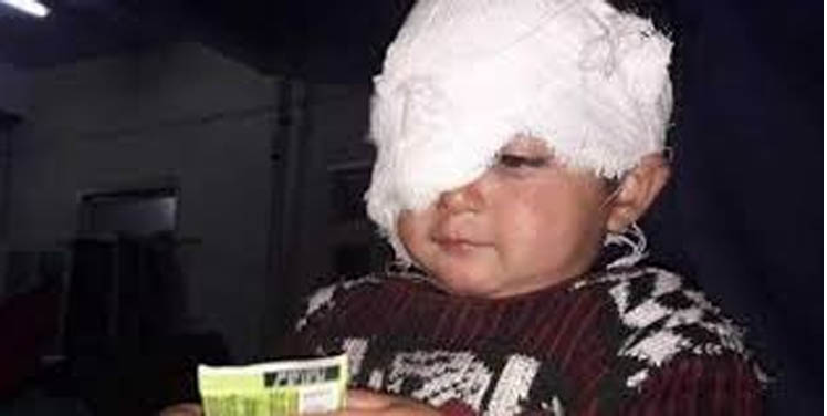PIL on Pellet Guns: High Court Seeks Report About Government Facilities to Pellet Victims