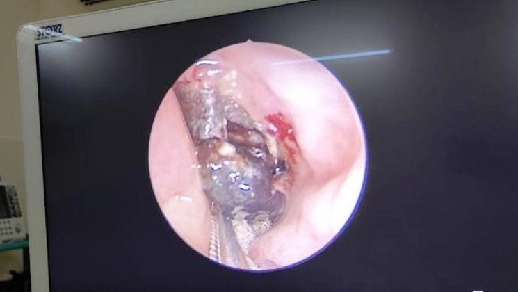 GMC Jammu conducts surgeries of Mucormycosis