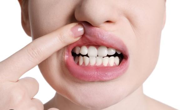 Frequent mouth ulcers? 5 potential health problems to watch out for